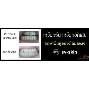 #เหงือกร่น #ปริทันต์อักเสบ #รำมะนาด รักษาที่ต้นเหตุอย่างได้ผลจริง LINE: sv-skin