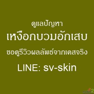 สามเหลี่ยมสีดำระหว่างซอกฟัน! สัญญาณร้าย โรคเหงือกอักเสบเรื้อรัง