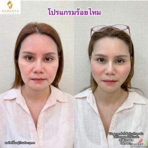 ร้อยไหมยกกระชับ 8.8
