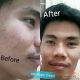 ใครเป็นสิว ฝ้า หน้าดำหมองบ้าง