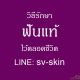เสี่ยงฟันโยก รากฟันผุ จากภาวะ โรคเหงือกอักเสบเรื้อรัง