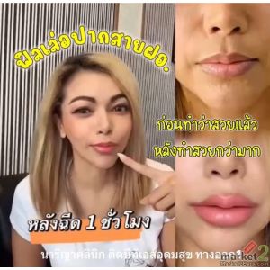ฟิลเลอร์ปาก