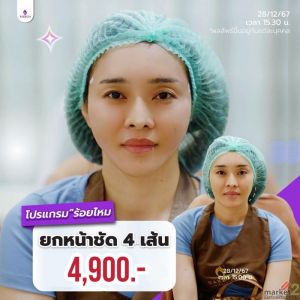 ร้อยไหมกรอบหน้า