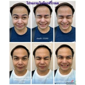 โบท็อกซ์ริ้วรอย 8 จุด