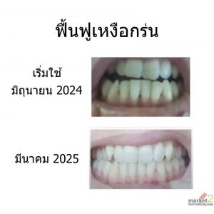 #รำมะนาด #เหงือกร่น #เหงือกบวมอักเสบ รักษาที่ต้นเหตุอย่างได้ผลจริง LINE: sv-skin