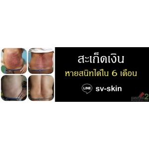 สะเก็ดเงิน หายสนิทได้ใน 6 เดือน..