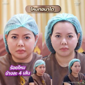 ร้อยไหมปรับรูปหน้าวีเชฟ