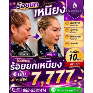 ร้อยไหมยกหน้า หรือ ยกเหนียง เลือกได้ค่ะ