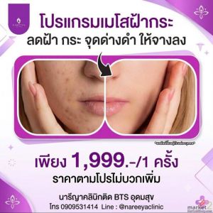 เมโสฝ้ากระ ลดรอยจุดด่างดำ